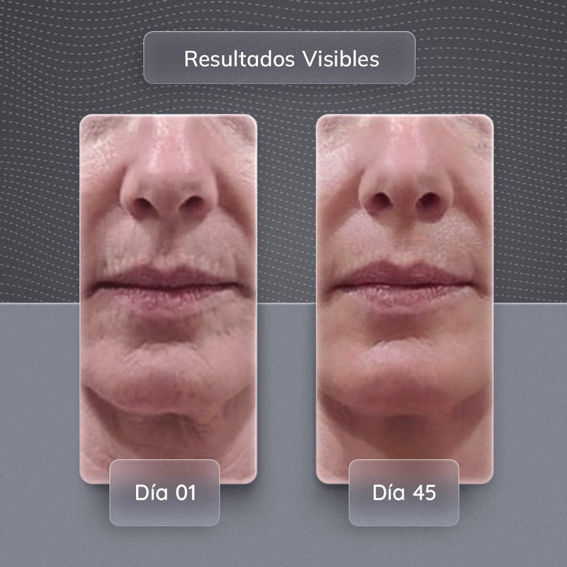 Rejuvenecimiento Facial Skindion™